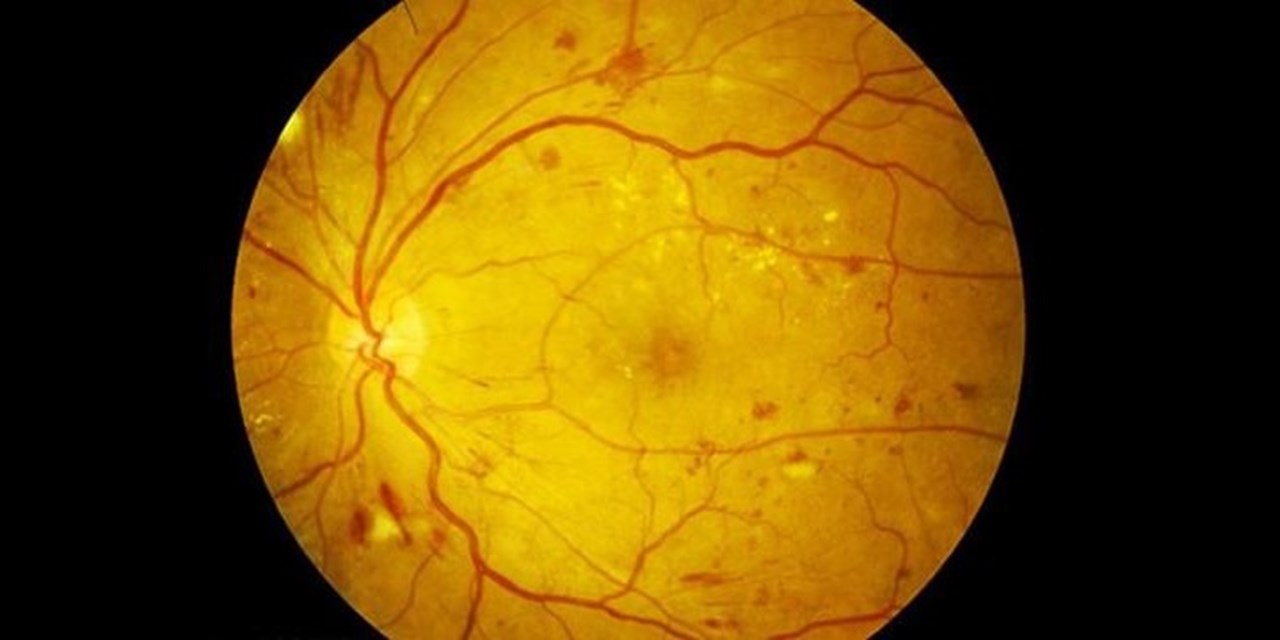 24.12.2024 Разработана дорожная карта для пациентов с сахарным диабетом и офтальмологическими осложнениями